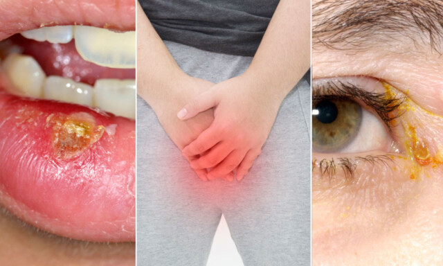 HERPES SIMPLEX: Blemmer og sår på munn og i underliv kan være en herpesinfeksjon. Foto: Bilder fra NTB Scanpix / Shutterstock. HERPES SIMPLEX: Blemmer og sår på munn og i underliv kan være en herpesinfeksjon. Foto: Bilder fra NTB Scanpix / Shutterstock.
